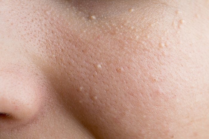Milia skin disease
